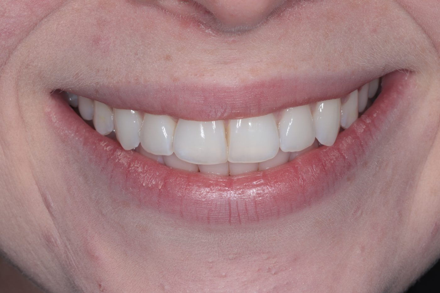 After Invisalign treatment