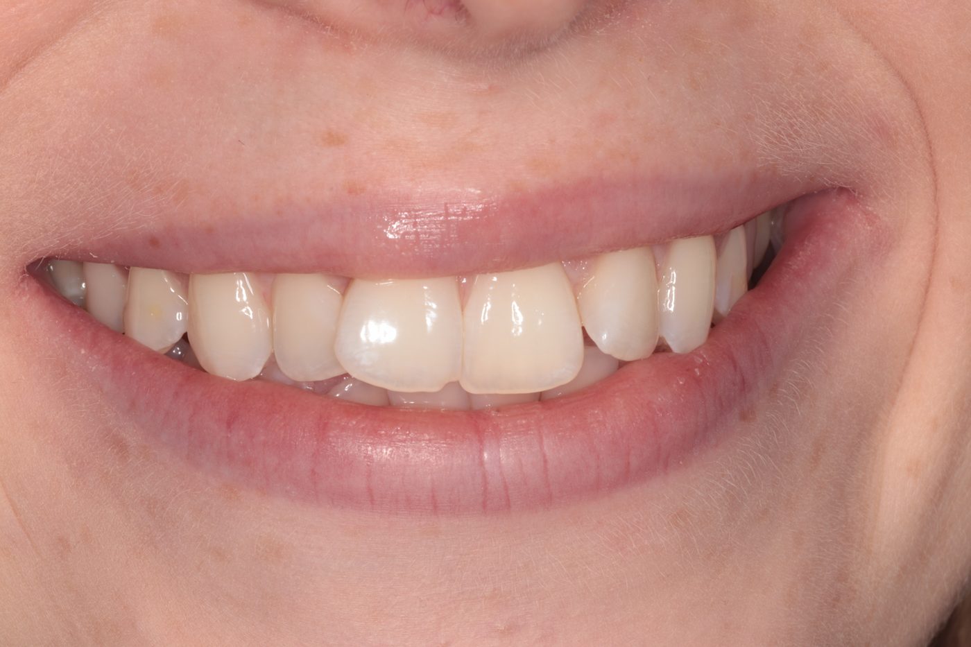 Before Invisalign treatment