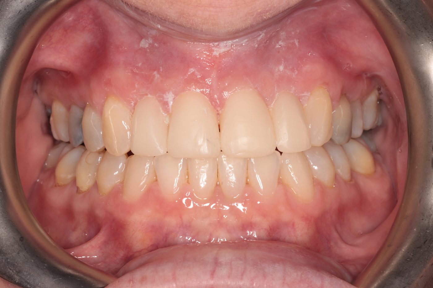 After Invisalign treatment, case one