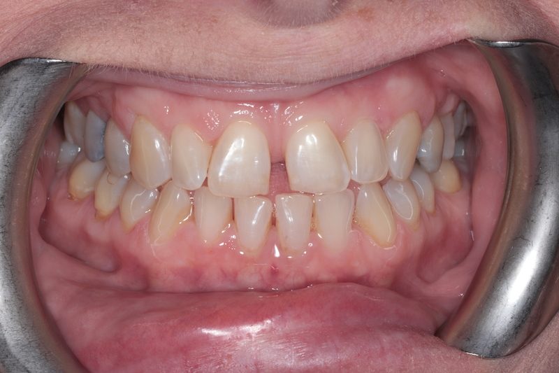 Before Invisalign treatment, case one