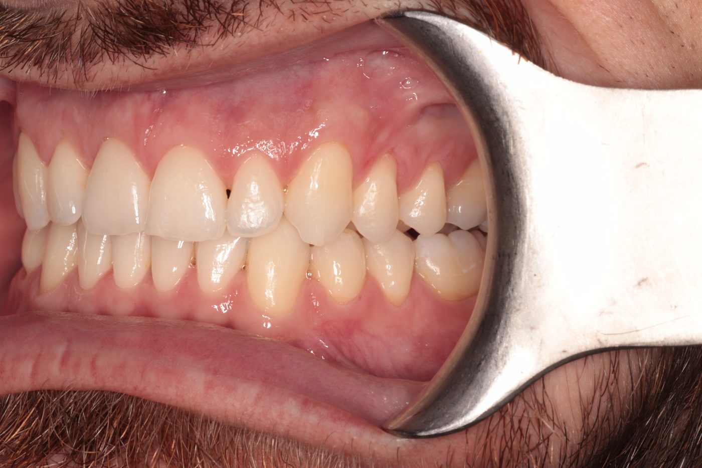 After Invisalign treatment, case two