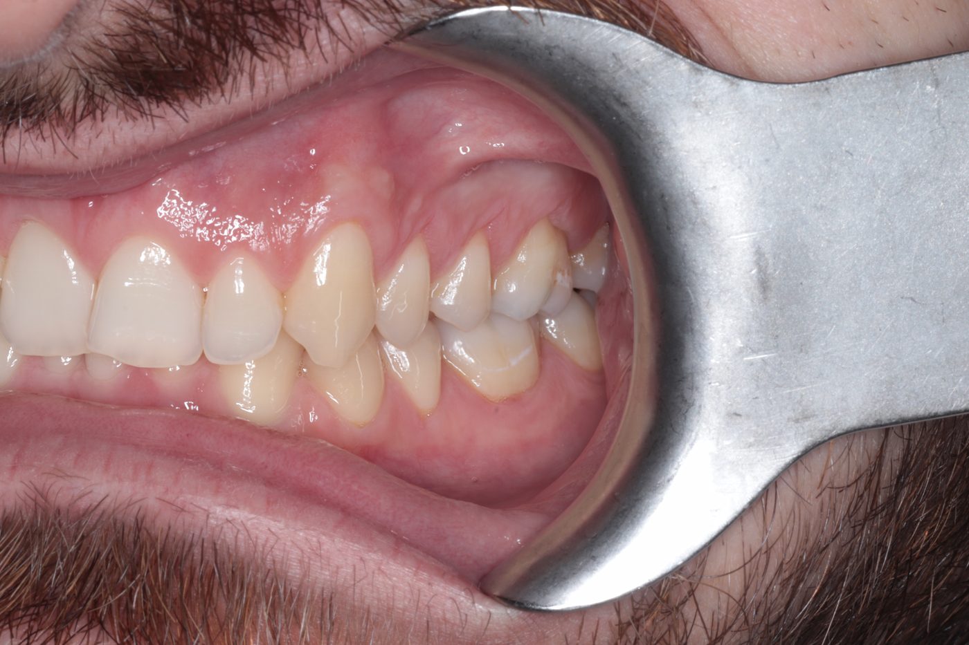 Before Invisalign treatment, case two
