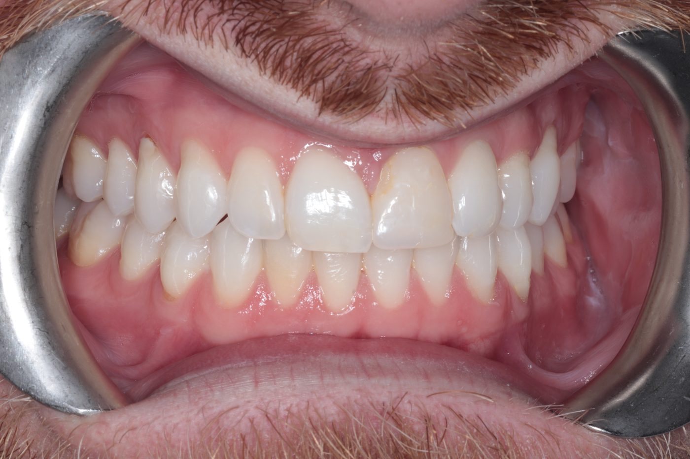 After Invisalign treatment, case three