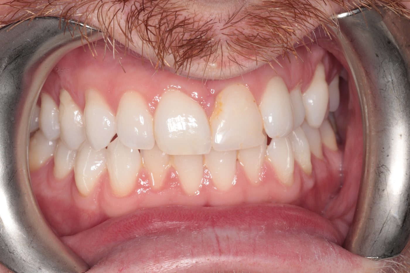 Before Invisalign treatment, case three