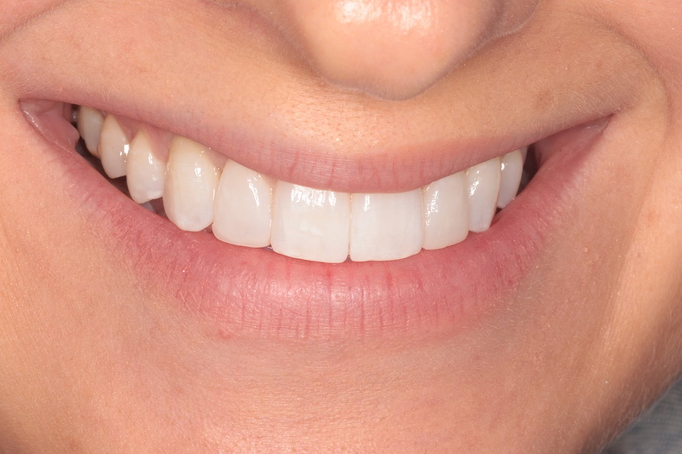 After Invisalign treatment, case five