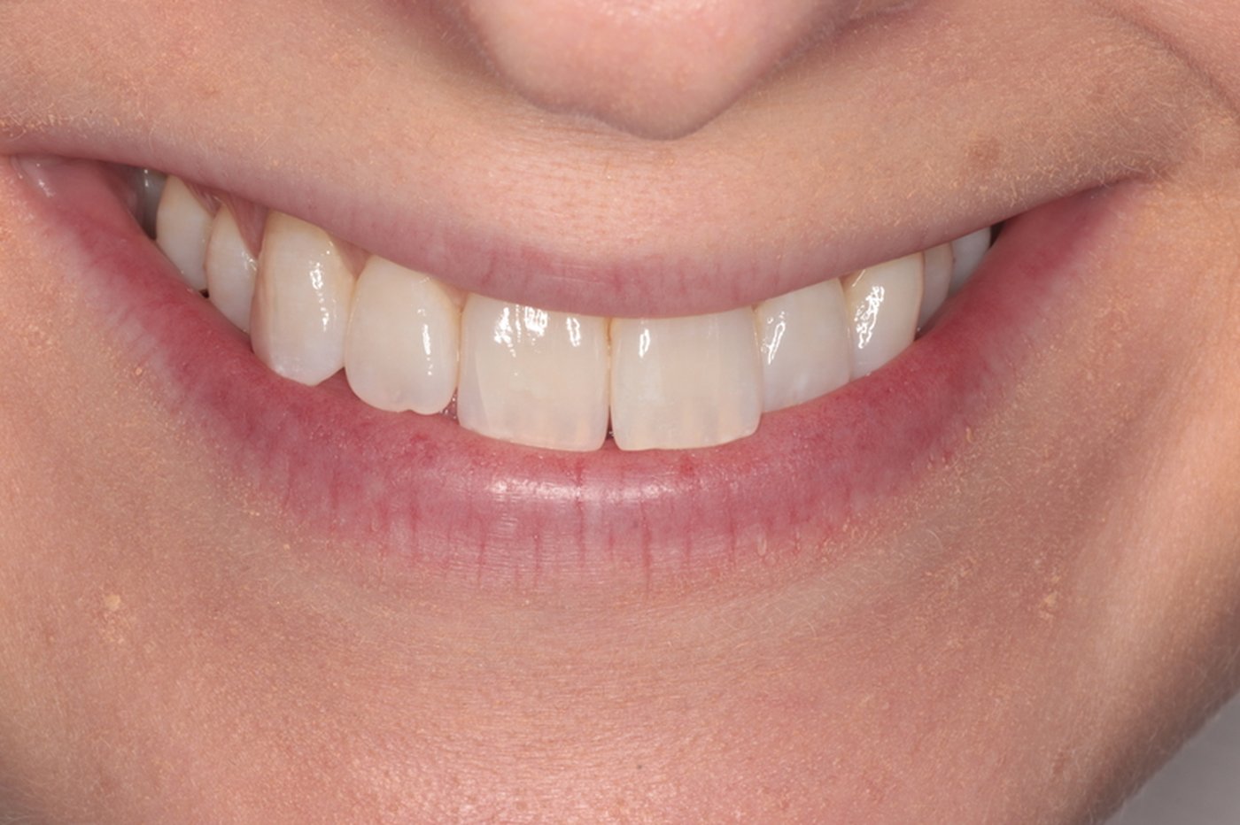 Before Invisalign treatment, case five